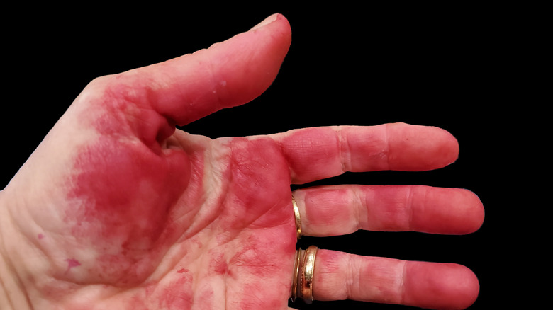 Stained hand from beet juice